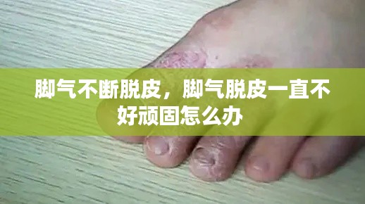 脚气不断脱皮,脚气脱皮一直不好顽固怎么办