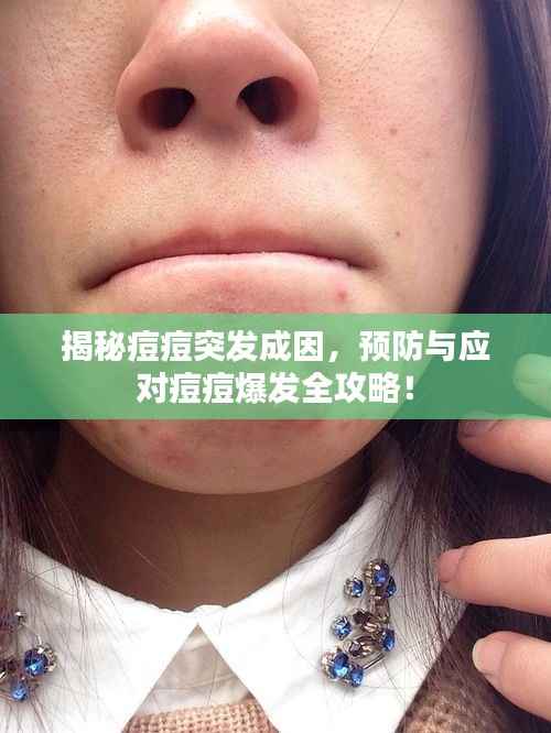 揭秘痘痘突发成因,预防与应对痘痘爆发全攻略!